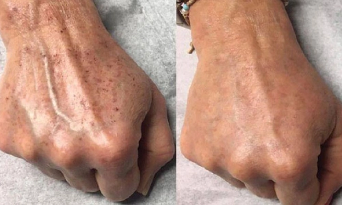 چرا باید مزوژل ضدلک خریداری کنیم؟
