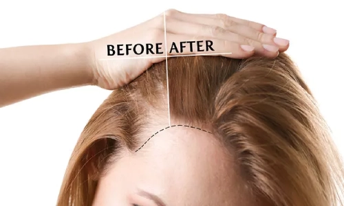 تاثیر کوکتل مزوتراپی بر ریزش مو چگونه اتفاق می‌افتد؟